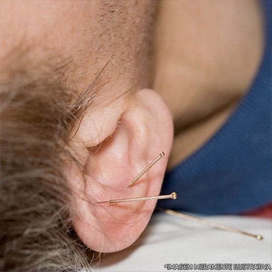 Agulha para Acupuntura Auricular para Comprar Tremembé - Agulha para Dry Needling