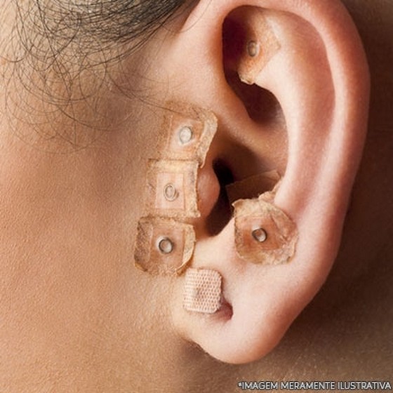 Agulha para Acupuntura Auricular Santana - Agulha para Dry Needling