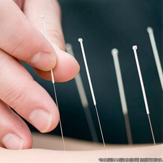 Agulha para Dry Needling Arujá - Agulha para Dry Needling