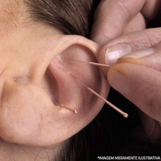 Onde Encontrar Agulha para Acupuntura Auricular Parque Edu Chaves - Agulha para Dry Needling