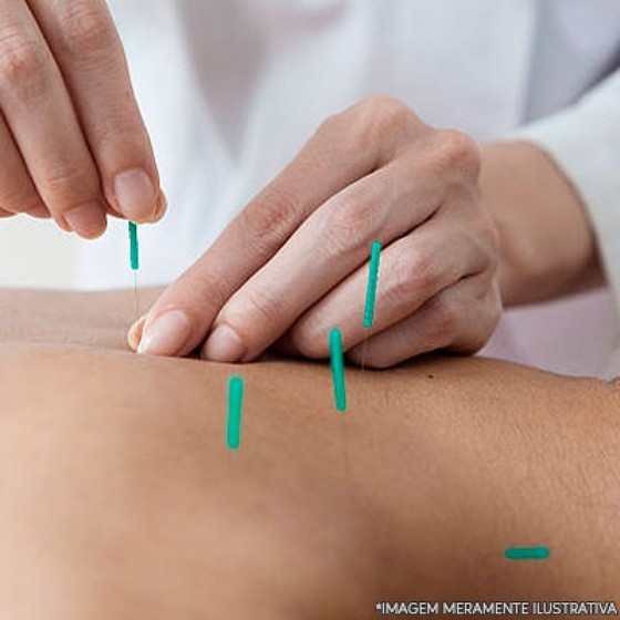 Onde Encontrar Agulha para Dry Needling Chora Menino - Agulha para Acupuntura Estética