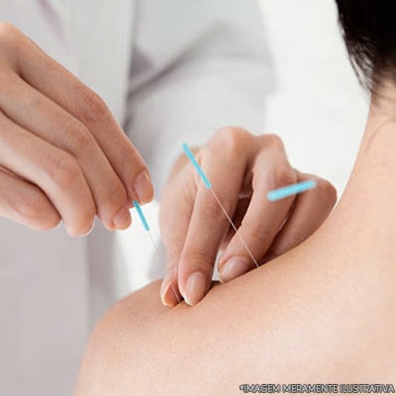 Onde Tem Agulha para Dry Needling Tatuapé - Agulha Acupuntura Individual