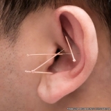 onde tem agulha para acupuntura auricular Tremembé